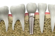 IMPLANTOLOGIA - Especialidades - Clinica Estomatológica Estoril Sol