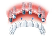 IMPLANTOLOGIA - Especialidades - Clinica Estomatológica Estoril Sol