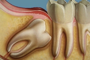 CIRURGIA ORAL - Especialidades - Clinica Estomatológica Estoril Sol