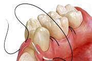 CIRURGIA ORAL - Especialidades - Clinica Estomatológica Estoril Sol