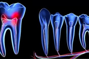 ENDODONTIA - Especialidades - Clinica Estomatológica Estoril Sol
